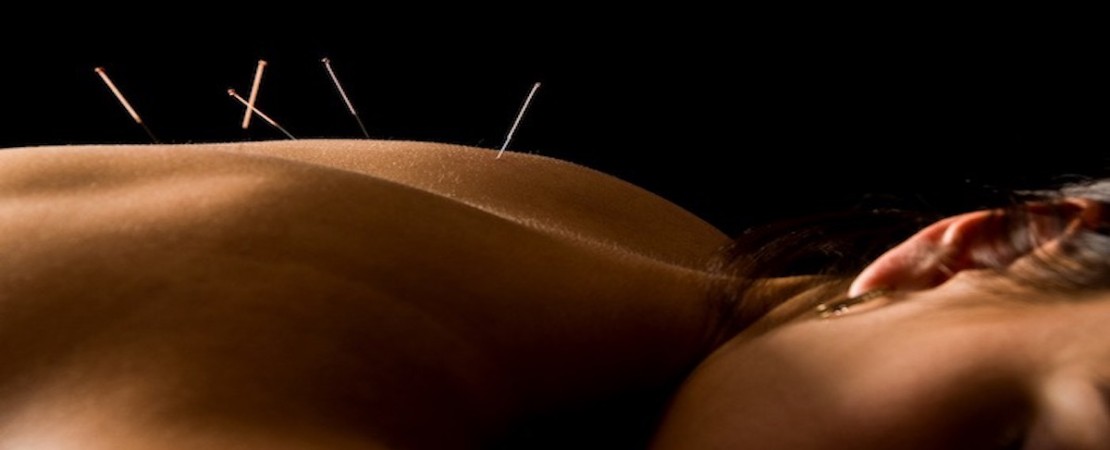 74- Constipation chronique sévère : l'acupuncture non inférieure au  prucalopride avec moins d'effets indésirables - Gera