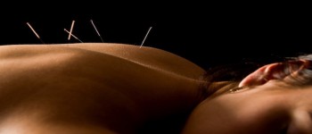 L’acupuncture permet-elle d’atténuer les symptômes du SII ?